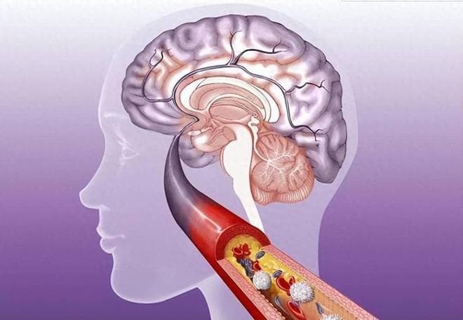 老年人出现5类症状，可能是脑梗，6类人群高危人群，做好预防