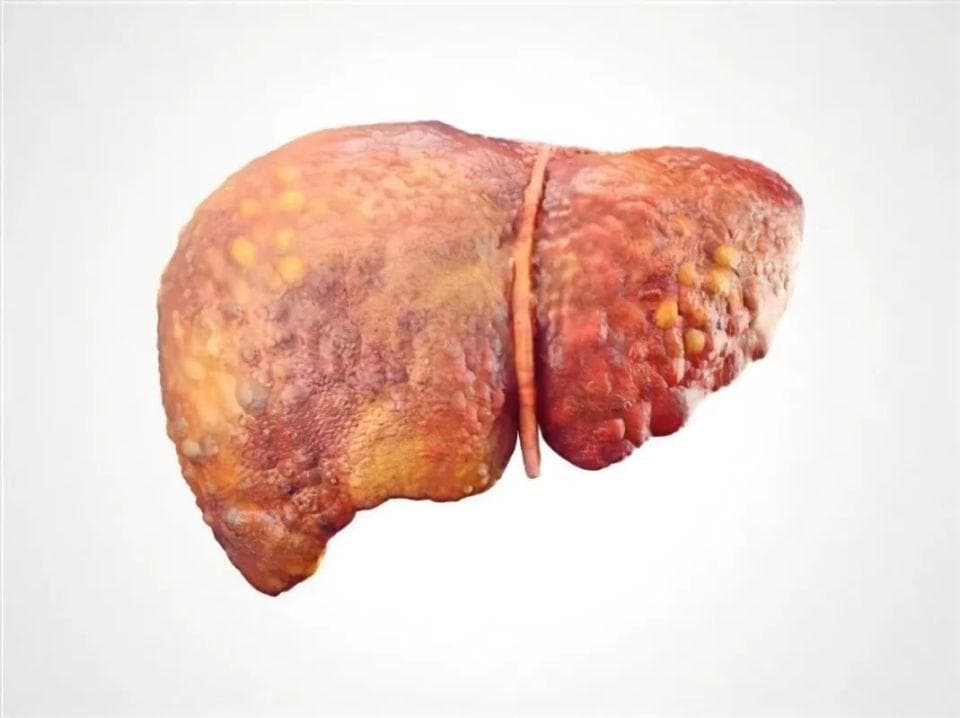 肿瘤复发，术后2年内是关键！肝癌患者术后如何选择辅助治疗？