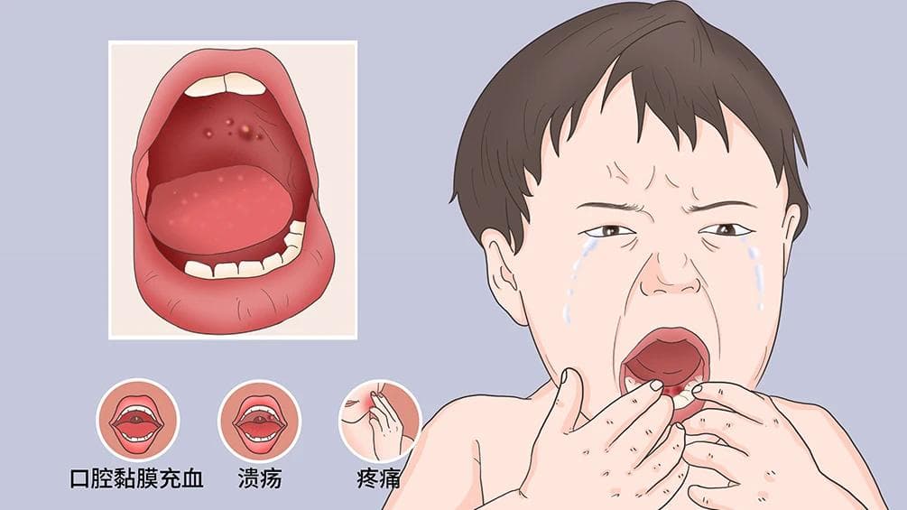揭秘舌炎：症状、危害与预防，让你的舌头重获健康！