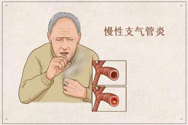 老慢支怎么治疗