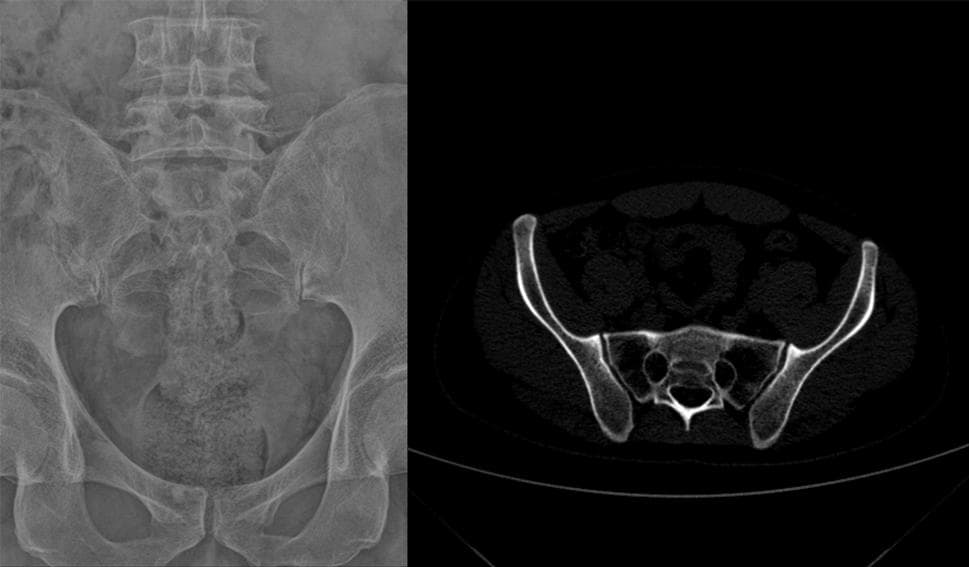 骶髂关节 MRI 如何诊断早期强直性脊柱炎