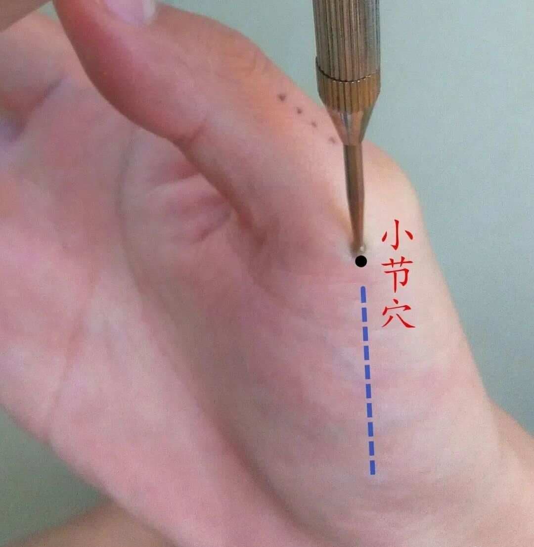 痛风——两穴止痛