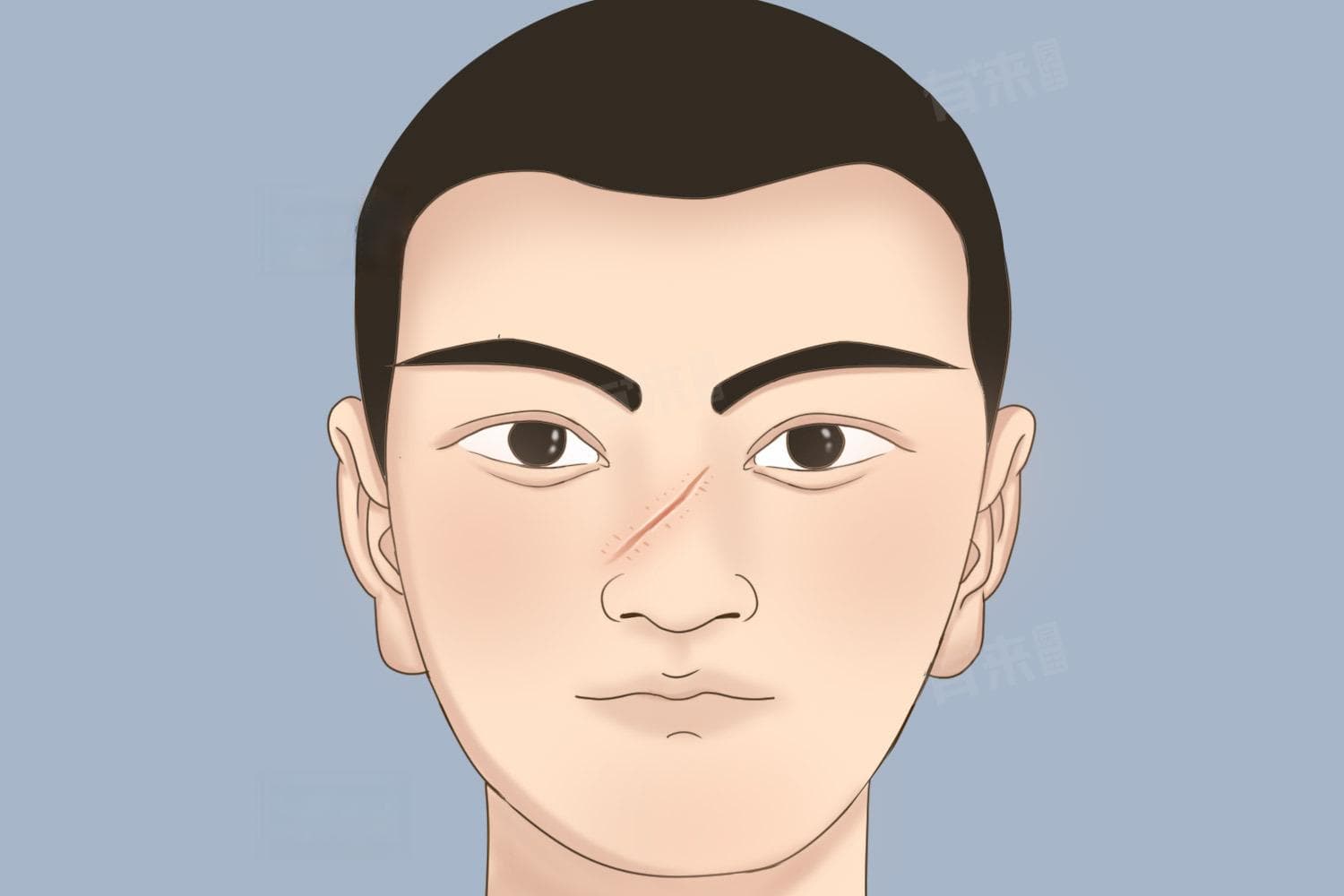 缝针后多久能碰水？伤口护理全攻略