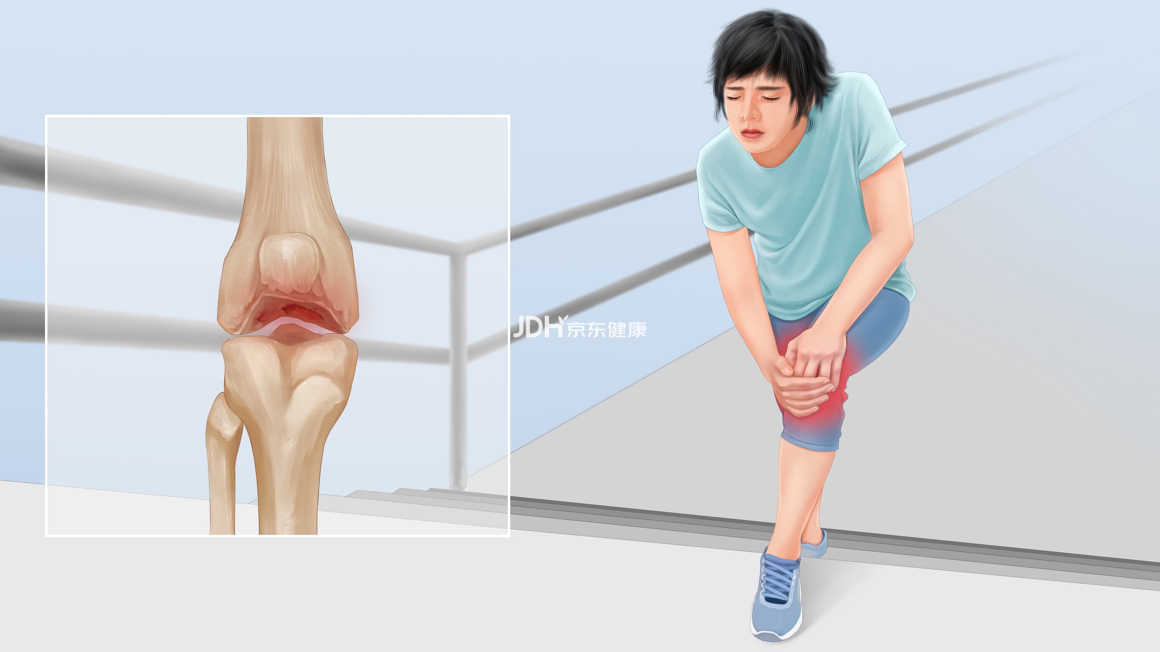 膝关节骨性关节炎：症状、诊断与治疗全解析