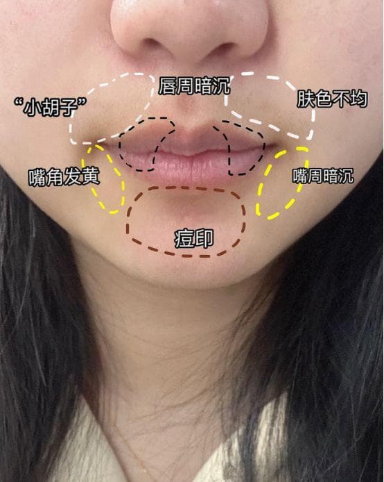 唇周黑怎么改善，在家就能轻松搞定