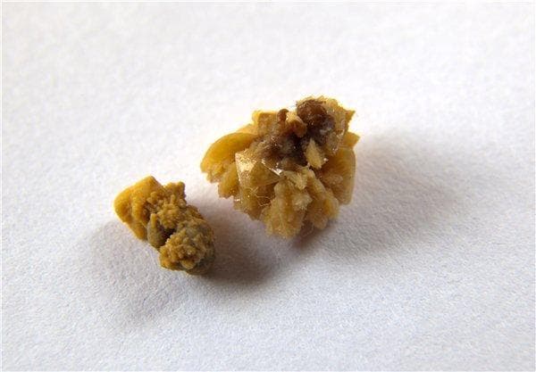 不是所有人都会有扁桃体结石