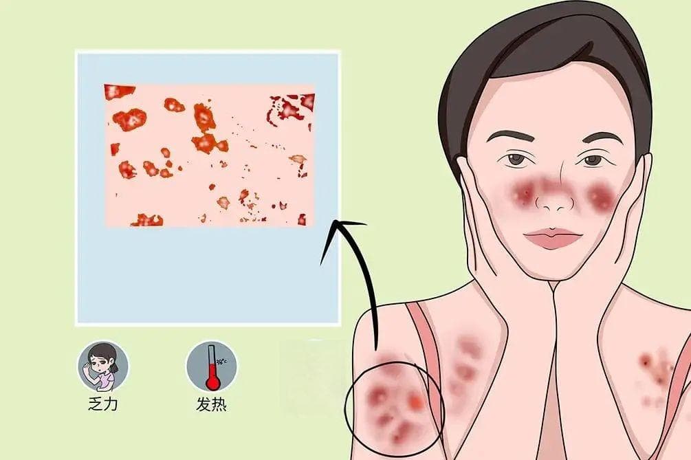 红斑狼疮病人能晒太阳吗?应注意些什么？