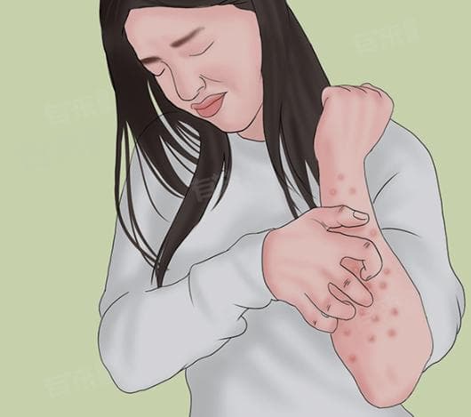 胆碱性荨麻疹如何除根