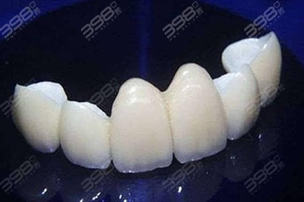 烤瓷牙/全瓷牙冠价格表：800元一颗是全瓷牙吗？全瓷和烤瓷有啥区别？