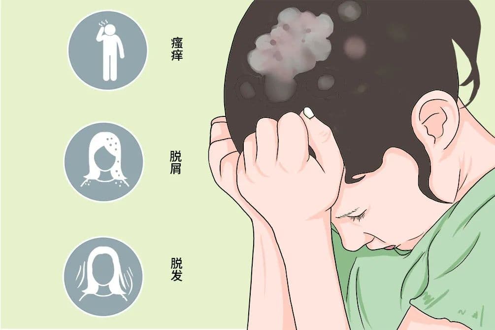 儿童脱发？小心头癣！