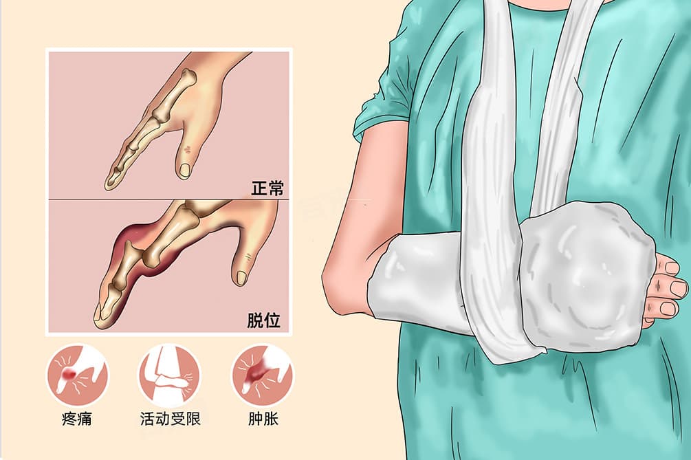 怎么判断小孩手脱臼