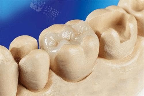 嵌体牙和全冠牙的对比：选择适合您的口腔修复方案