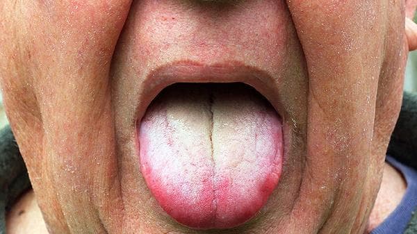 舌癌：形成原因、症状及应对措施全解析