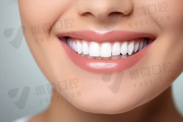 树脂牙贴面与全瓷牙贴面哪种更优？深入分析两者的优缺点