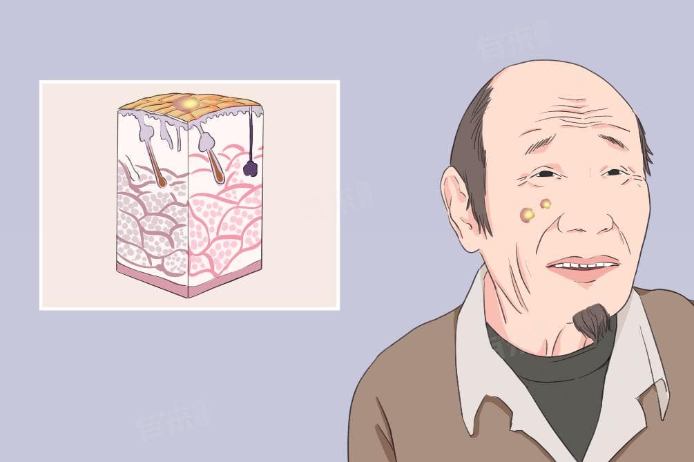 鳞癌的临床表现