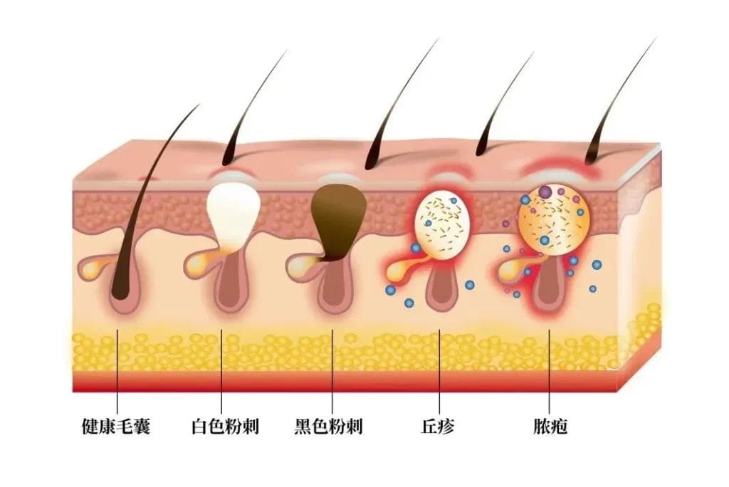 黑头与脂质微丝的区别及有效去除方法