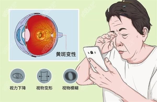 眼睛看东西变形扭曲是什么原因？是近视的前兆吗怎么处理