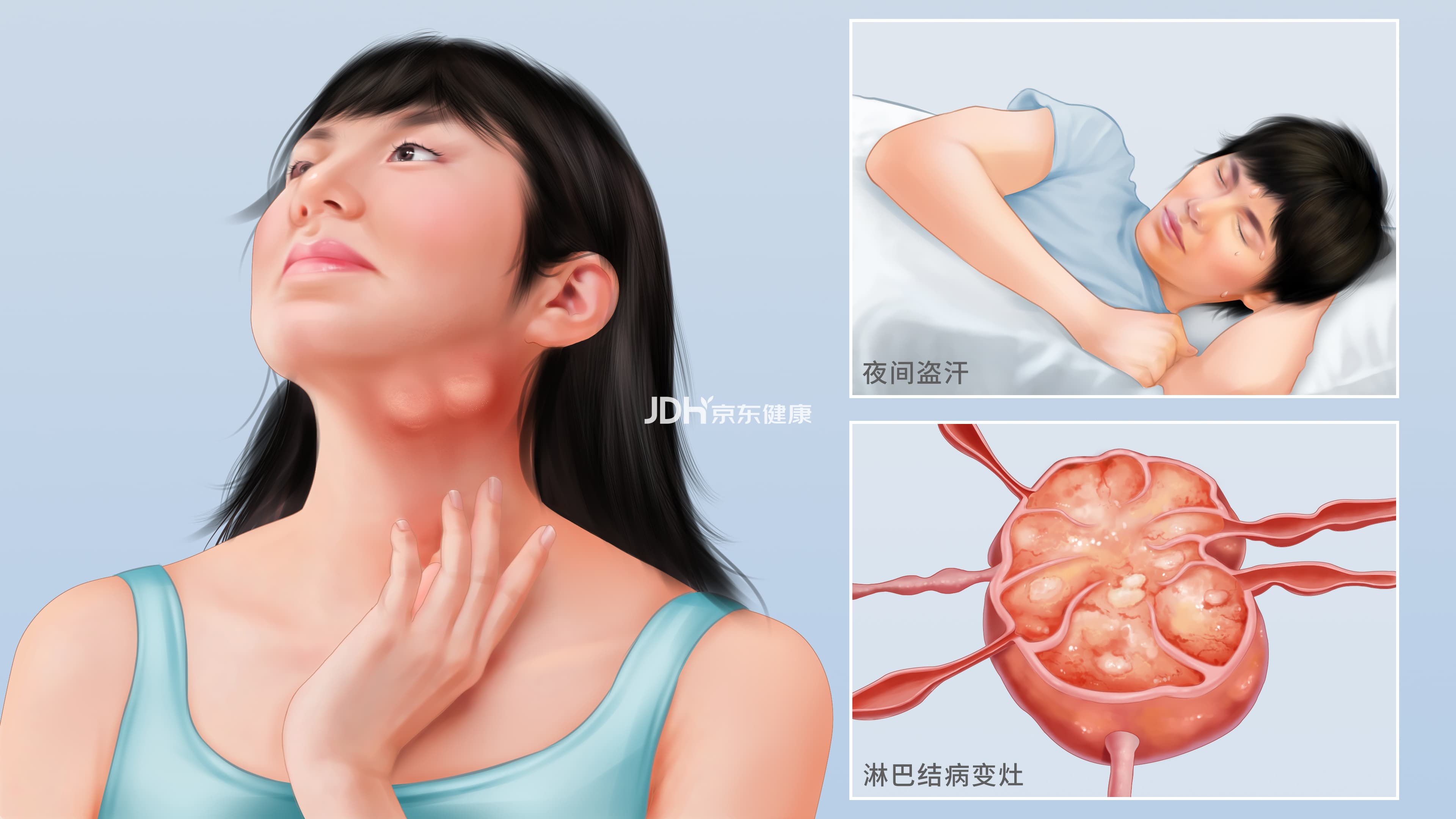 霍奇金淋巴瘤：症状、诊断与治疗全解析