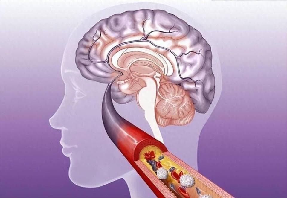 老年人出现5类症状，可能是脑梗，6类人群高危人群，做好预防