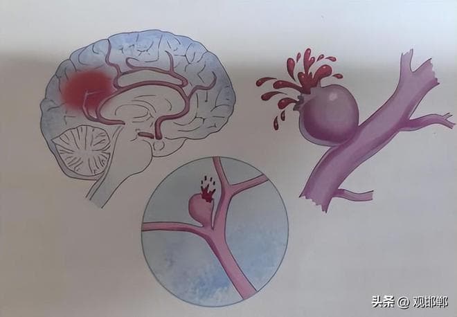 高血压性脑出血：早期识别，预防为先