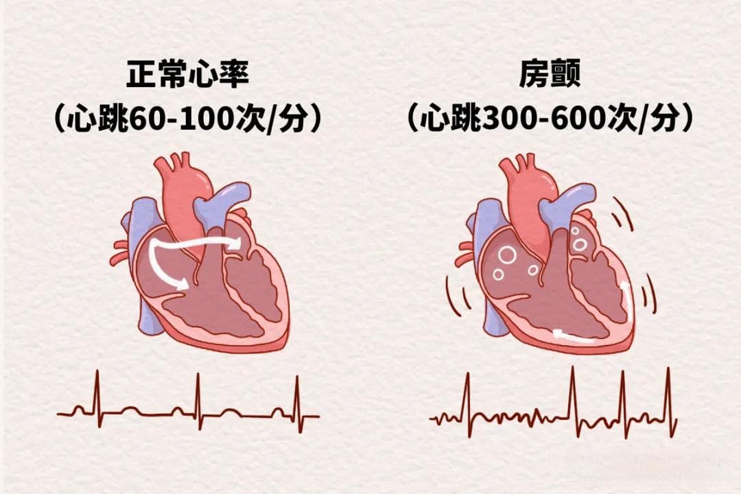松山医院成功开展心腔内超声（ICE）指导下房颤消融手术