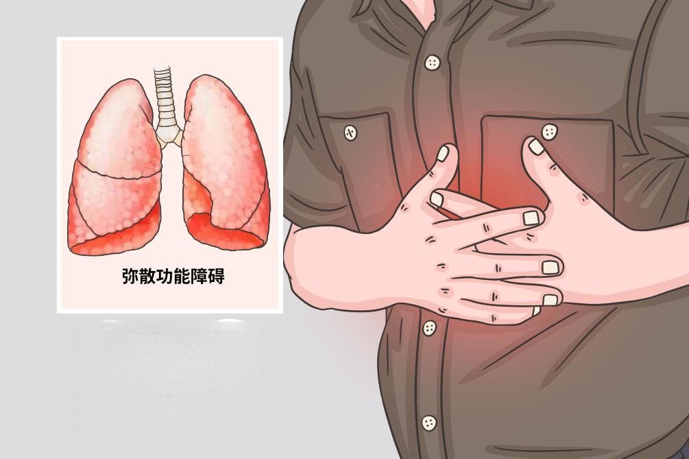 肺弥散功能障碍