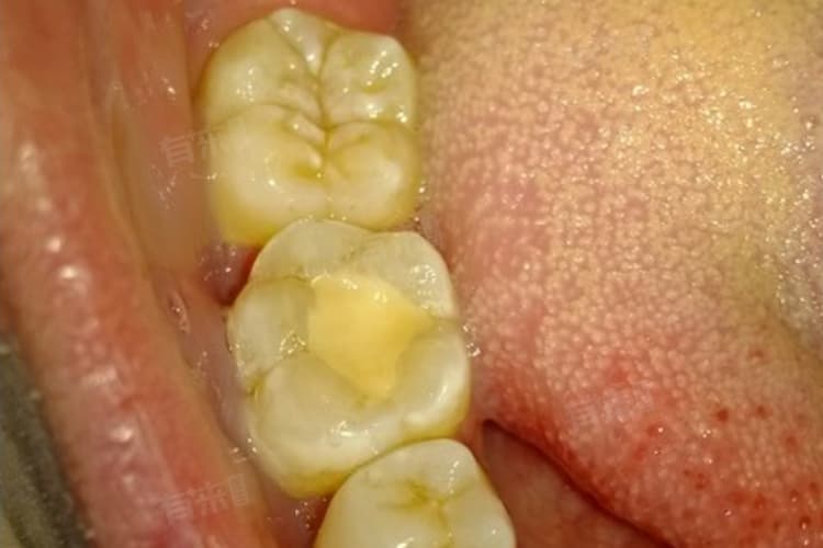 补个牙多少钱？一文详解补牙费用及注意事项
