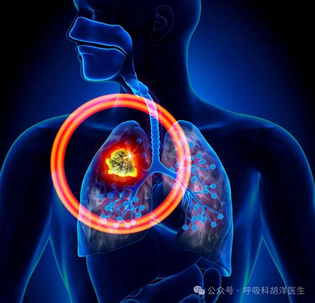 肺癌基因检测到底起到什么作用，哪一种肺癌做基因检测白花钱？