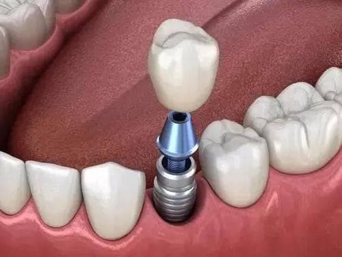 磁共振成像检查解析：辐射误区、假牙疑问与安全指南