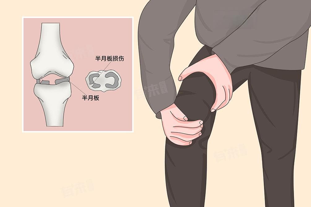 半月板损伤一辈子就完了是真的吗