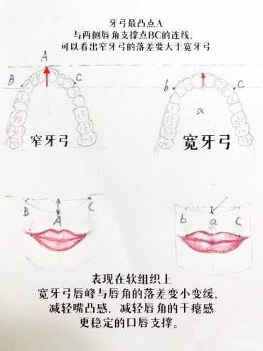 扩弓器矫正牙齿图片类型及原理清晰明了,6种类型牙齿矫正扩弓器+矫治4大问题