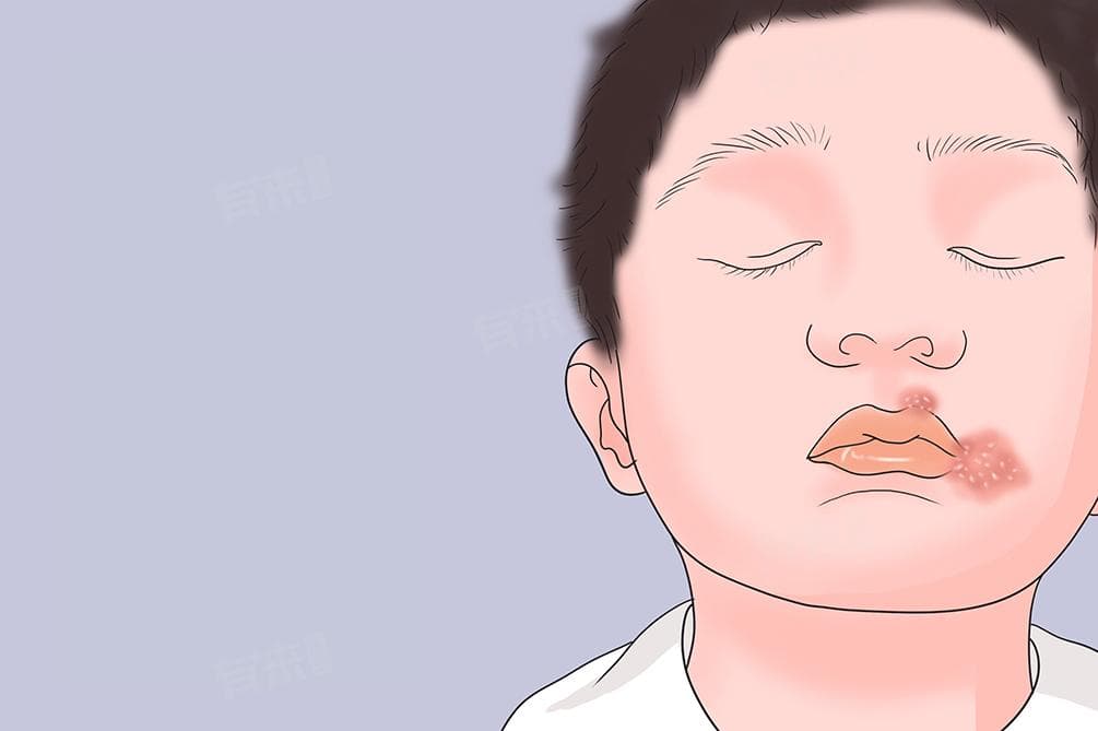 口角炎怎么治最快速有效