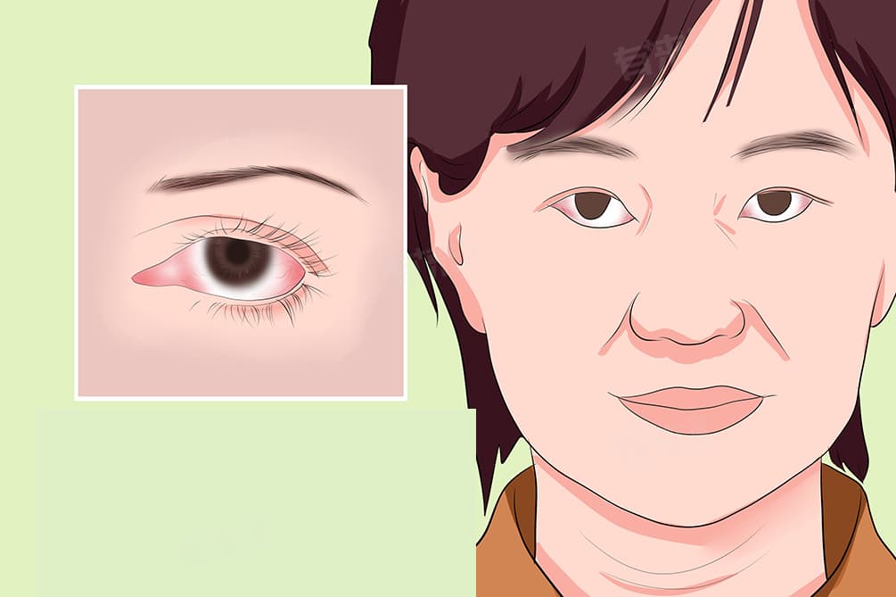 什么叫红眼病