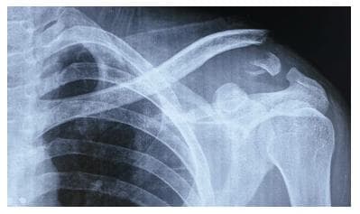 Orthop Rev：钩钢板内固定治疗急性肩锁关节脱位和锁骨远端骨折的疗效