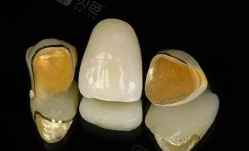 装一颗普通假牙多少钱?不同材质/不同地区收费各异,价格区间300~1.5万都有!