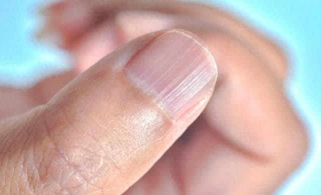 指甲有竖纹是疾病前兆？教你通过饮食和护理恢复健康指甲！