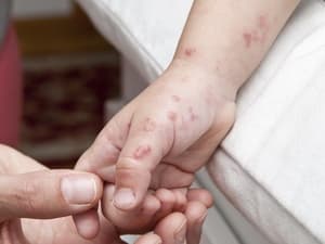 盐酸伐昔洛韦正确的使用方法是什么