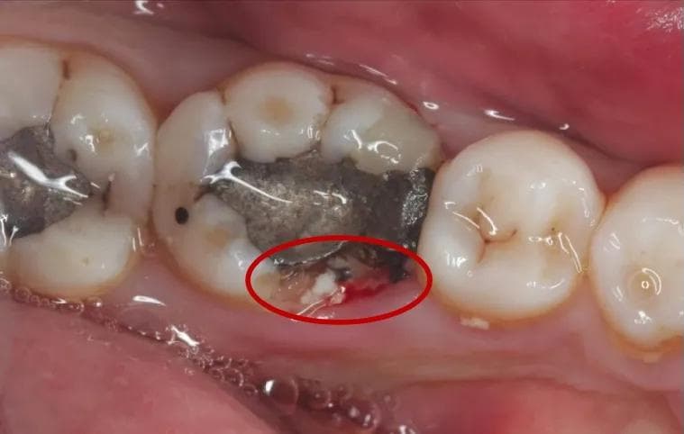 根管治疗后牙医建议做牙冠，有这个必要吗？