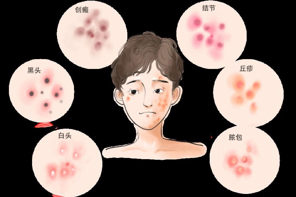 专家解析：闭口粉刺成因与三大治疗方案