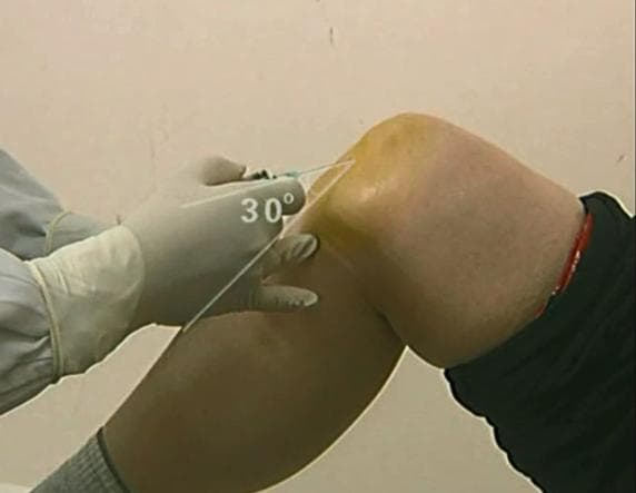 骨科精读 | 20种关节腔穿刺技术详解