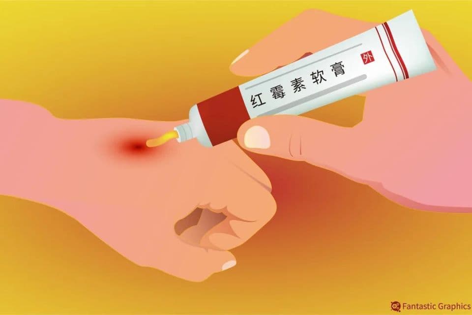 红霉素软膏使用指南：这些误区你可能也踩过