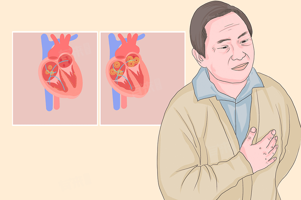 心房颤动的原因