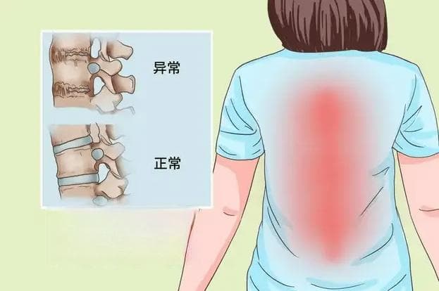 一文详解：强直性脊柱炎的7个诊疗要点！