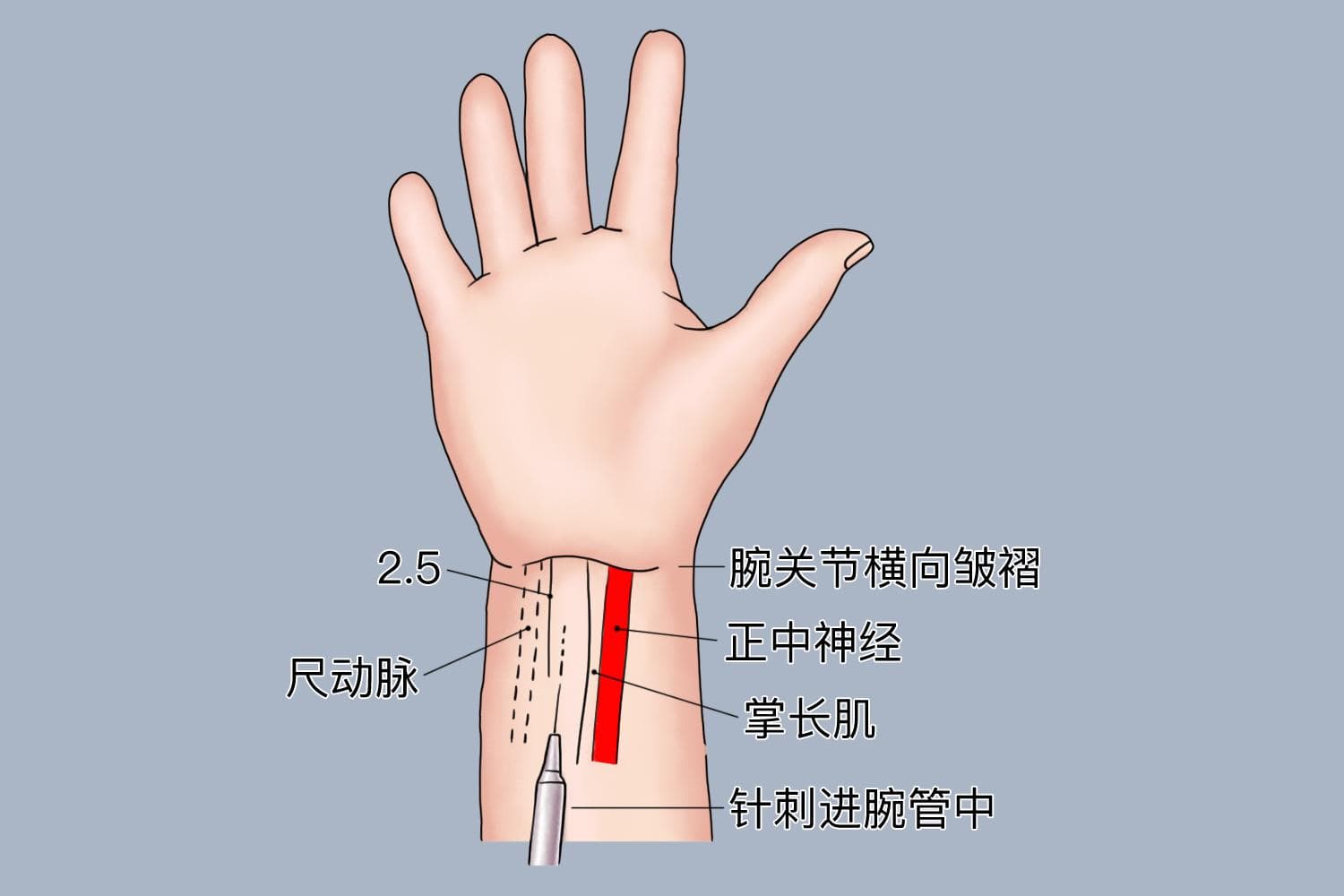 打封闭针是什么意思