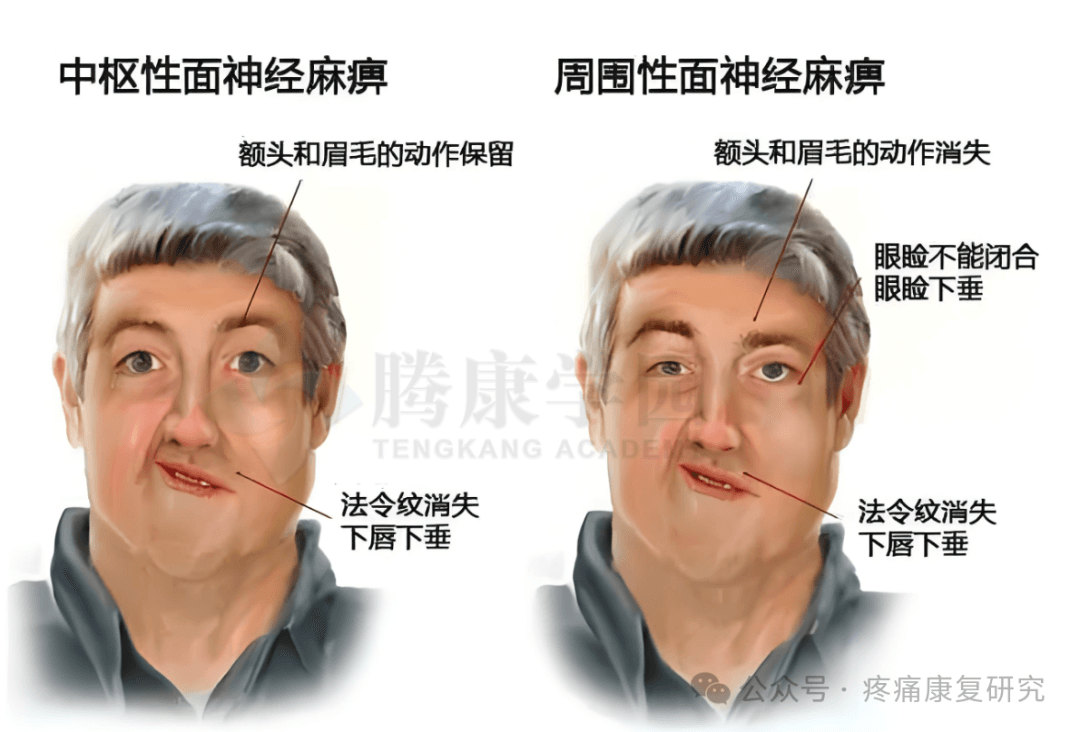 中枢性面瘫 VS 周围性面瘫