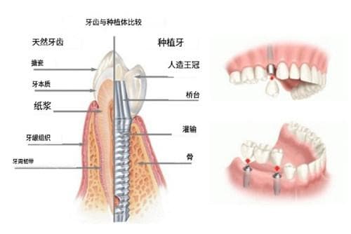 2025种植牙“价格预言”：还会便宜吗？有人说有望下降？一文带你深度分析