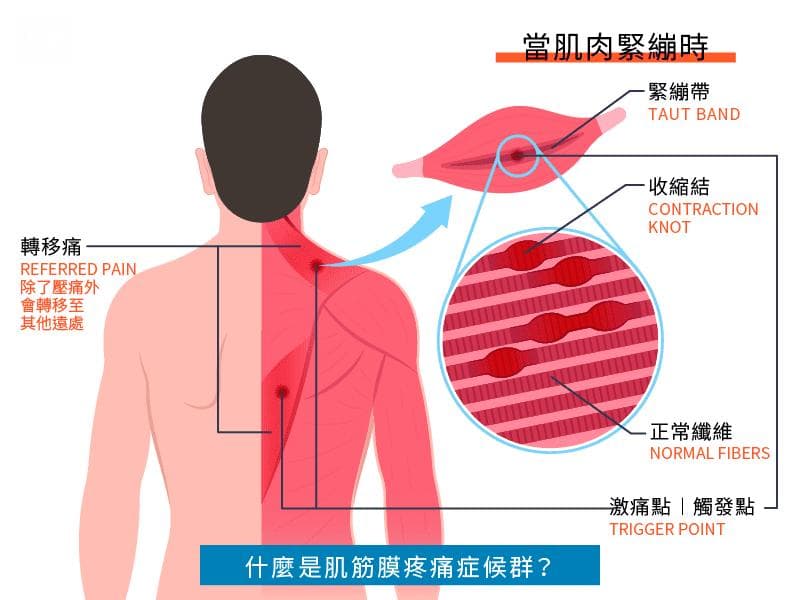 身体紧绷、僵硬、疼痛？可能是肌筋膜疼痛症候群作祟