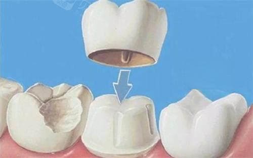全瓷牙全部费用多少钱?从品牌到材料再到医生技术,全方面解析全瓷牙修复全部费用!