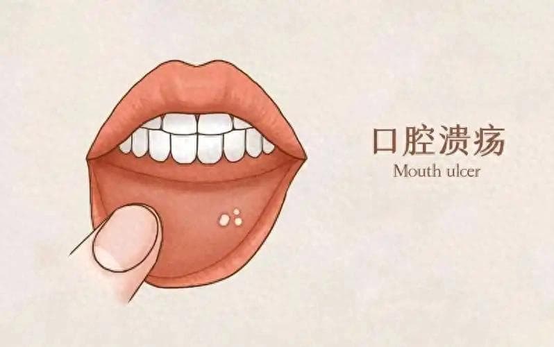 口腔溃疡反反复复发作，9个因素易患病，日常做好5个预防