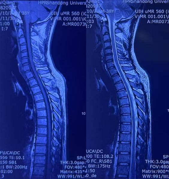 齐鲁医院神经外科常规开展硬膜外血液贴片治疗原发性低颅压综合征